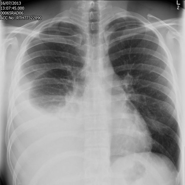 Lung x-ray