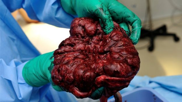 Placenta