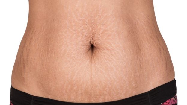 Woman's stomach with stretch marks