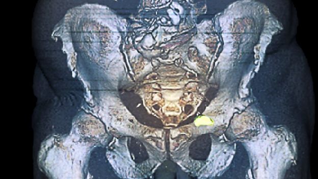 Prostate cancer