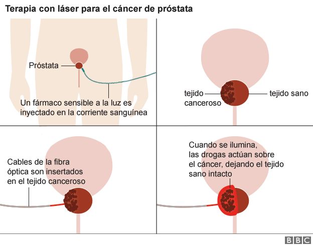 secuelas tratamiento cancer de prostata