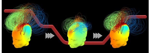 Participants with robust brain networks at the start (left head) remained resistant to the sedative, while others showed weaker networks during unconsciousness (middle). All regained similar networks when the drug wore off (right).