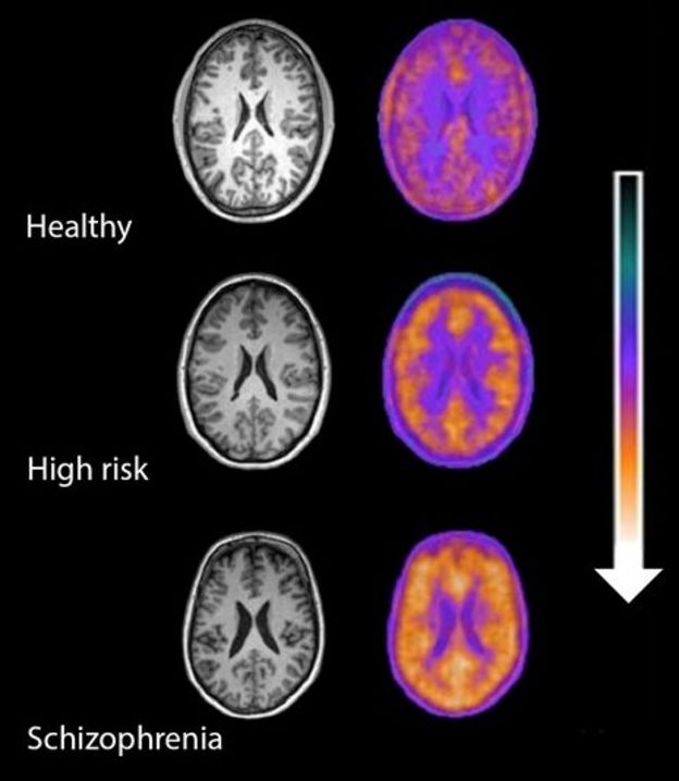 Immune clue to preventing schizophrenia