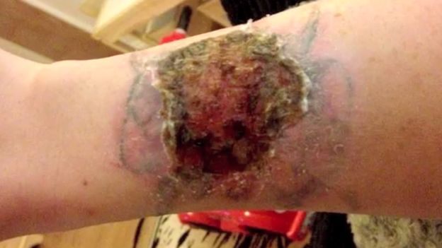 Tacoma Laser Clinic | Tattoo 'removal' kits burning victims