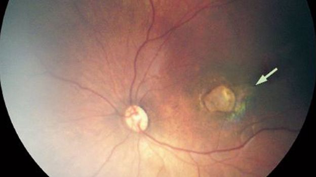 Lesão ocular em bebê com microcefalia
