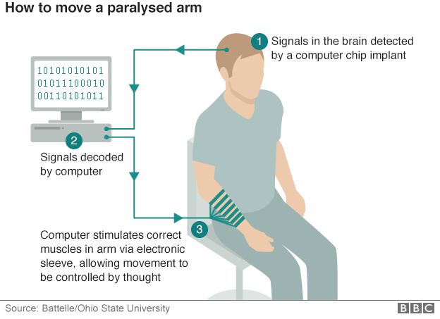 How to move a paralysed arm