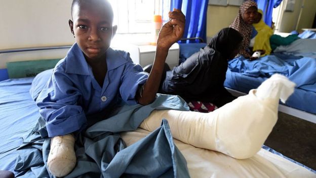 Twelve-year-old Isa Lawan sits with a bandaged stump on his right arm after his hand was amputated following injuries from a Boko Haram attack in Maiduguri, capital of northeast Nigerian Borno State, on February 4, 2016