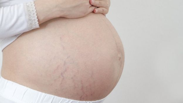 Woman's stomach with stretch marks