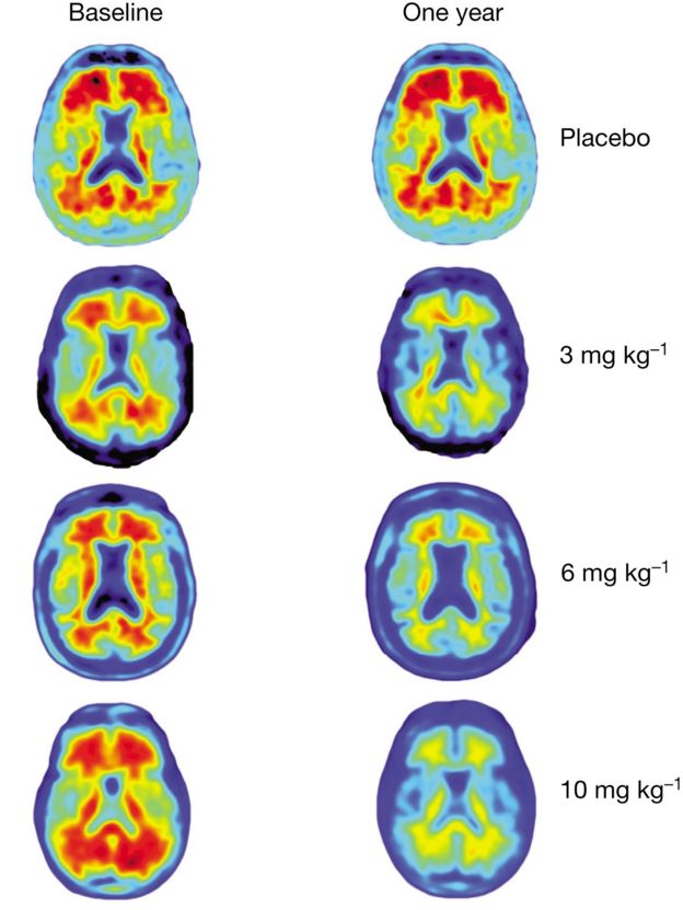 Brain scans showing effects of treatment