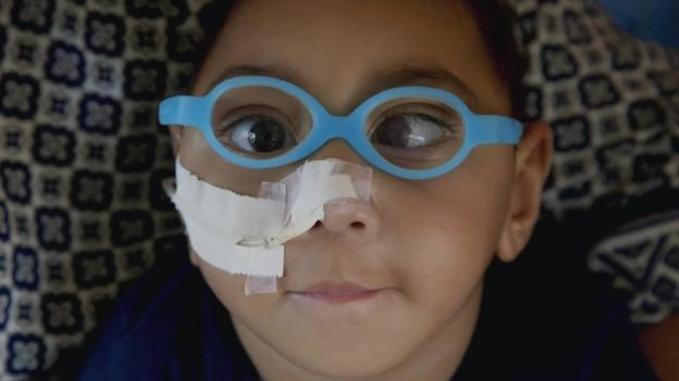José Wesley, afectado por el virus del Zica, a los 16 meses de edad