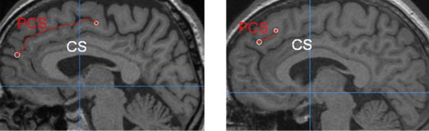 two brain scans showing one long and one short PCS