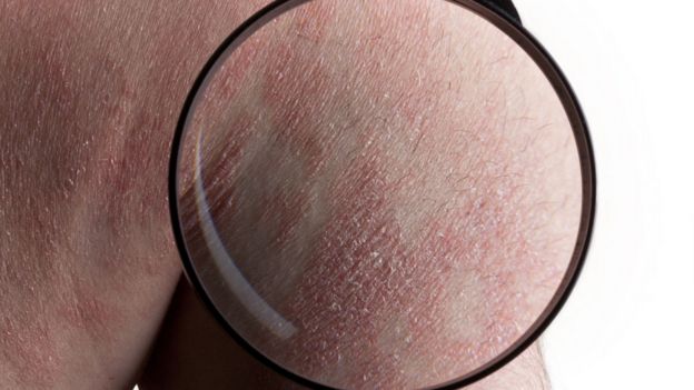 Piel con psoriasis