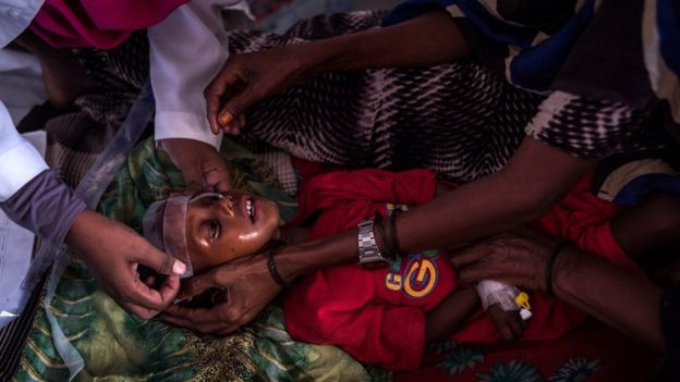 Un niño con desnutrición en Somalia es atendido por médicos