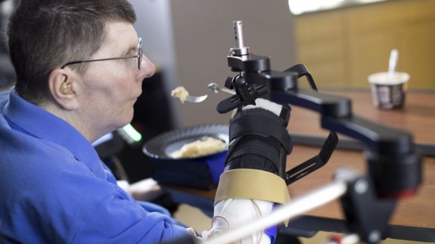 مصاب بالشلل يطعم نفسه باستخدام شريحة زرعت في مخه