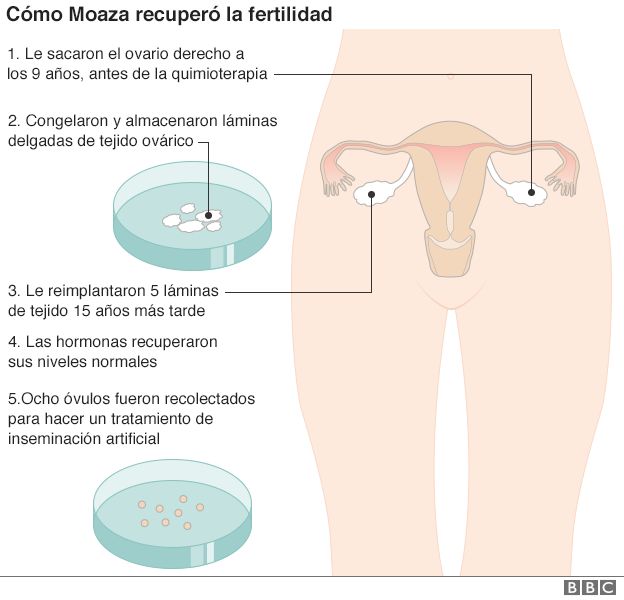 Gráfico que explica el tratamiento de Moaza