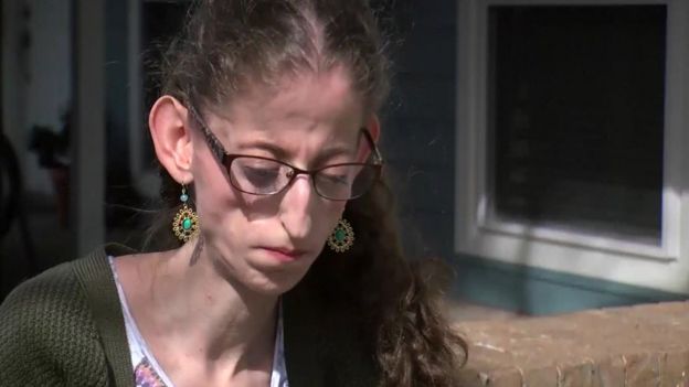Abby Solomon, estudiante de 21 años que padece síndrome progeroide neonatal