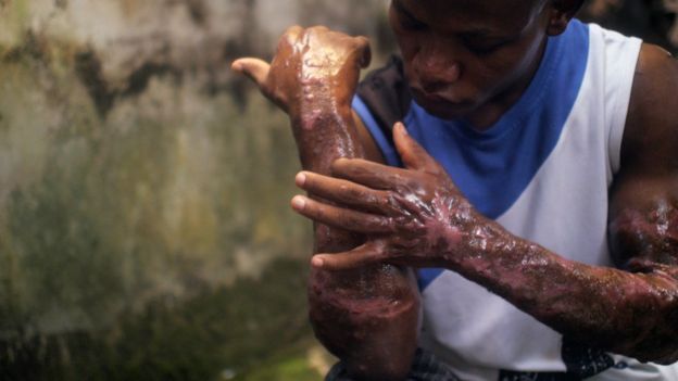 A man cradles a severely burned arm in an Amnesty-provided photo