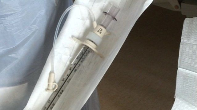 Ventilation tube