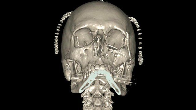 A graphic of a human skull