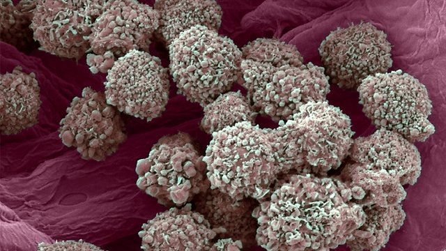 Breast cancer cells under the microscope