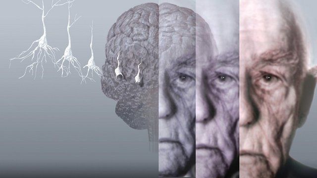 Conceptual computer artwork showing the brain of an elderly man affected by Alzheimer's disease.