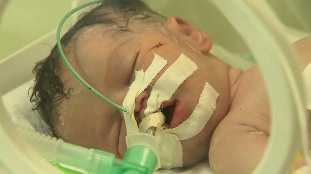 Baby delivered from mother's dead body