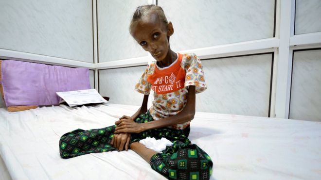 Saida Ahmad, sentada na cama do hospital em Sana'a