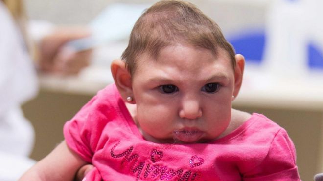 A baby girl with microcephaly