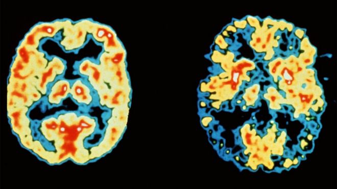 Dementia, including Alzheimer's Disease, has overtaken heart disease as the leading cause of death in England and Wales, latest figures reveal.
