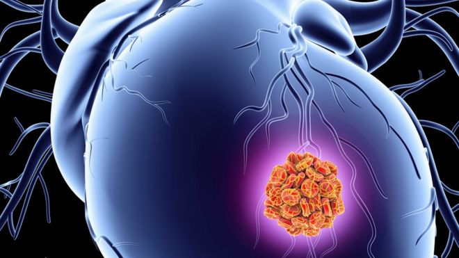 During a heart attack, heart muscle cells die because of a lack of oxygen