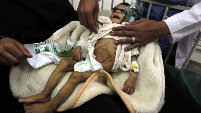 Child being treated for malnutrition in Sanaa.