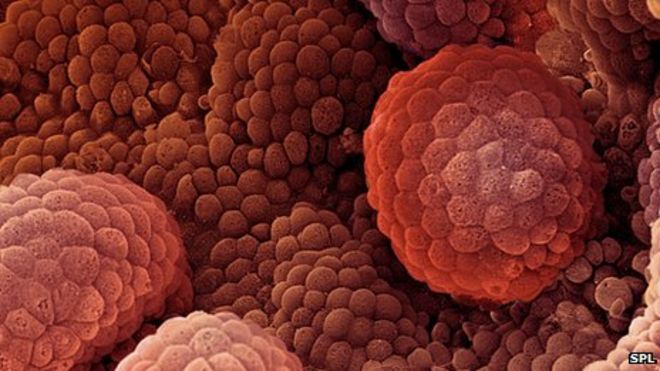 Types of Prostate cancer