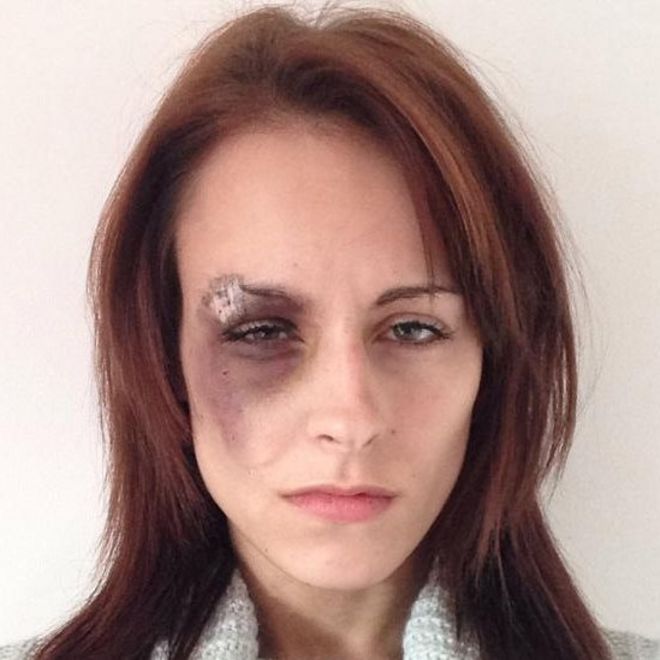 Image caption Five days after she was punched, Katrina-Kay Hayward still has no sight in her right eye - _78823865_78823864