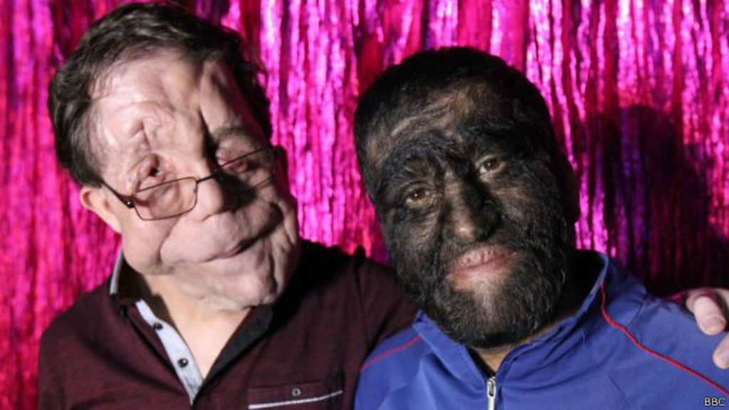 "Tú eres el Hombre Elefante de nuestros días" BBC Mundo