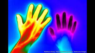 Синдром Рейно, Мэтью Клейви, Thermal Vision Research