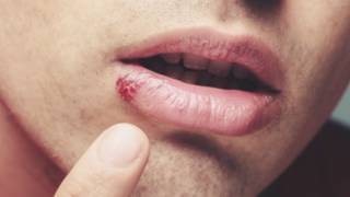 Herpes 151029185728_herpes_624x351_thinkstock_n