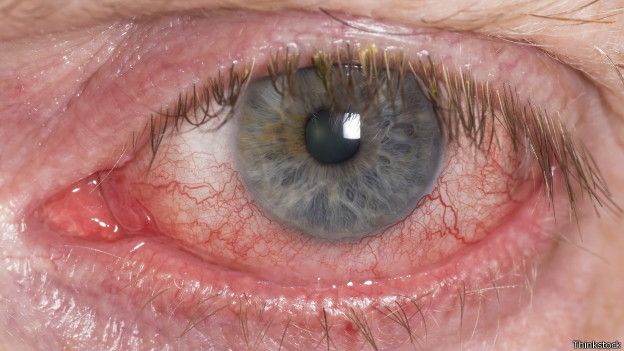 Ojo rojo