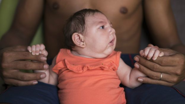 Luiza, bebê com microcefalia nascida em Pernambuco | Foto: AP