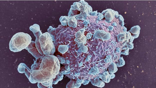 Tumor pada kanker payudara
