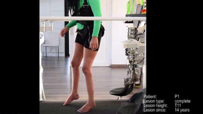 برنامج تعليم المشي يعيد قدرات المصابين بالشلل
