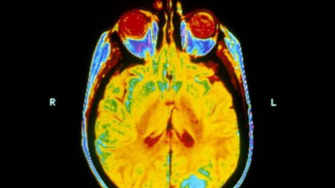 العلاج الإشعاعي للمخ "غير مفيد" لمرضى سرطان الرئة