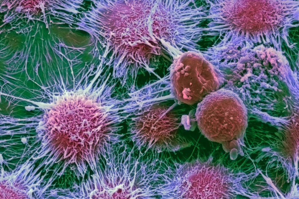 Tế bào một loại ung thư