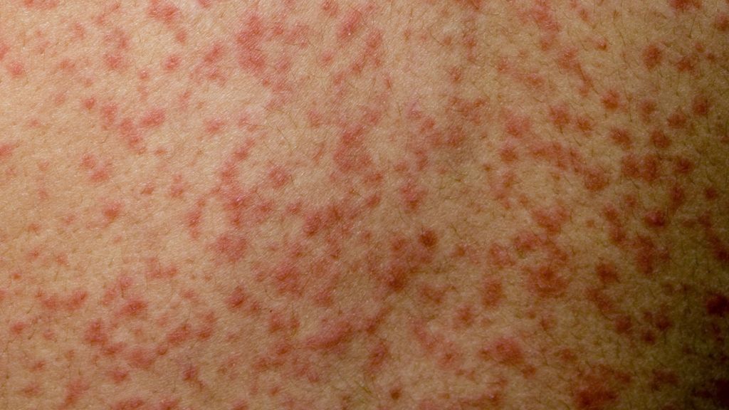 Measles Cases In Uk 2024 Eartha Renell