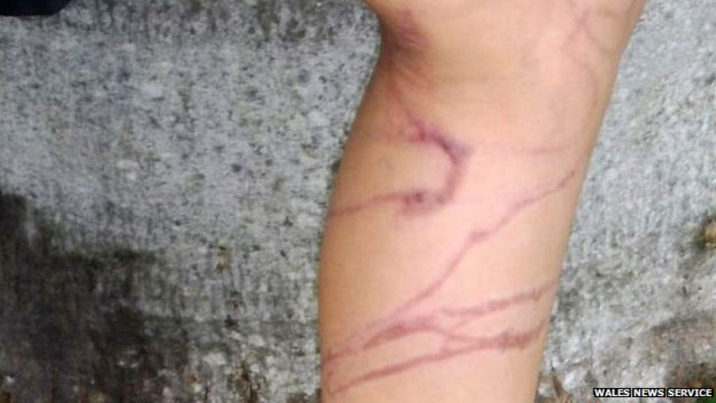 'Terrified' girl, 10, goes into shock after jellyfish sting BBC News