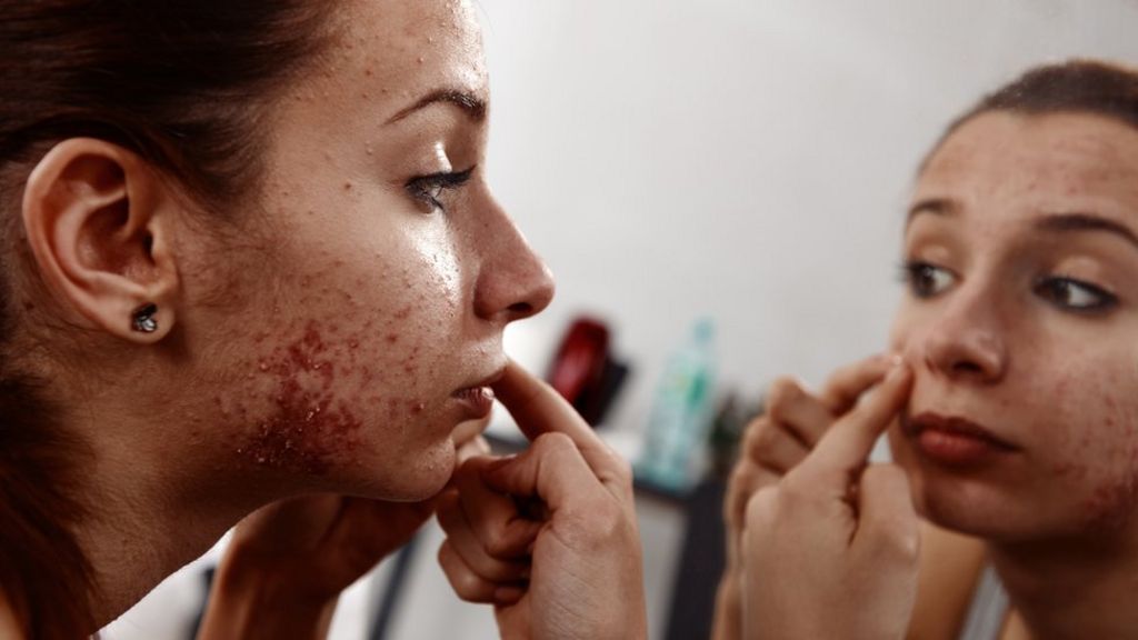 Concern over rise in acne drug use