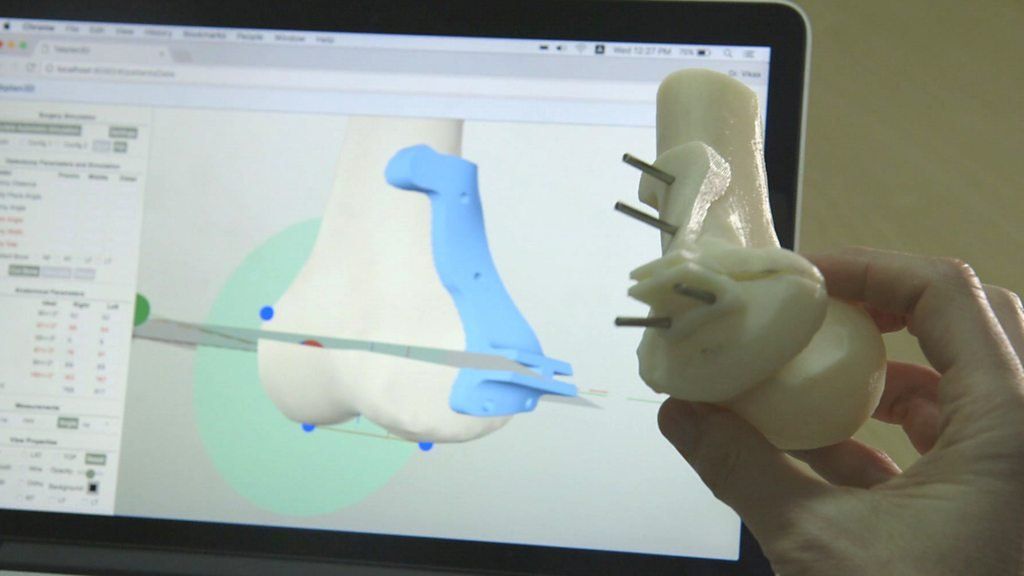 Software turns 2D X-rays into 3D images to aid surgeons