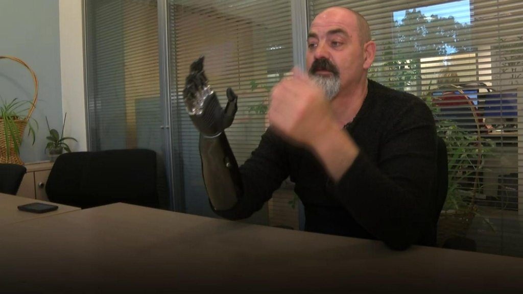 The man on a prosthetic hand mission