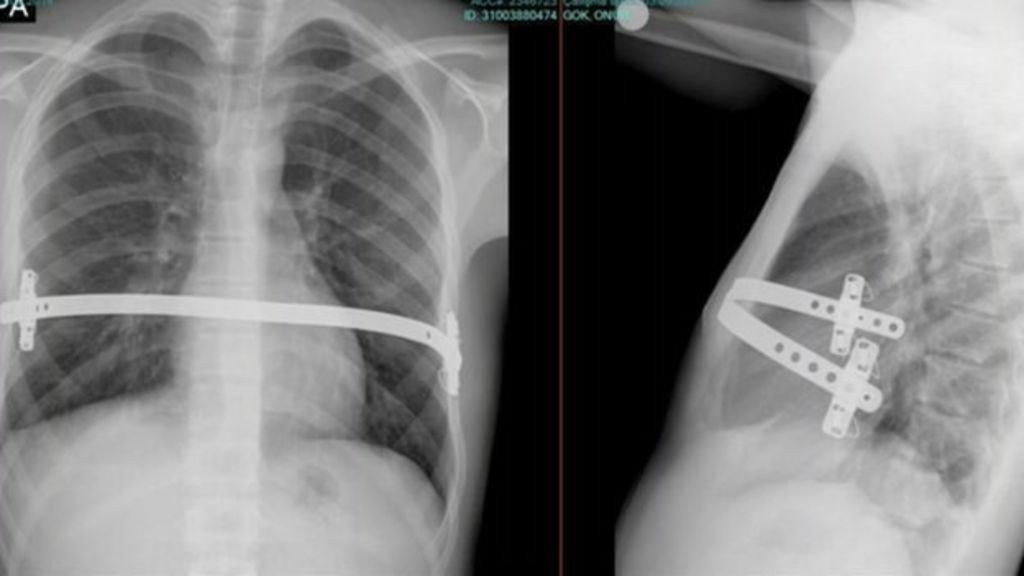 Pioneering Chest Deformity Op Carried Out At Cardiff Hospital Bbc News