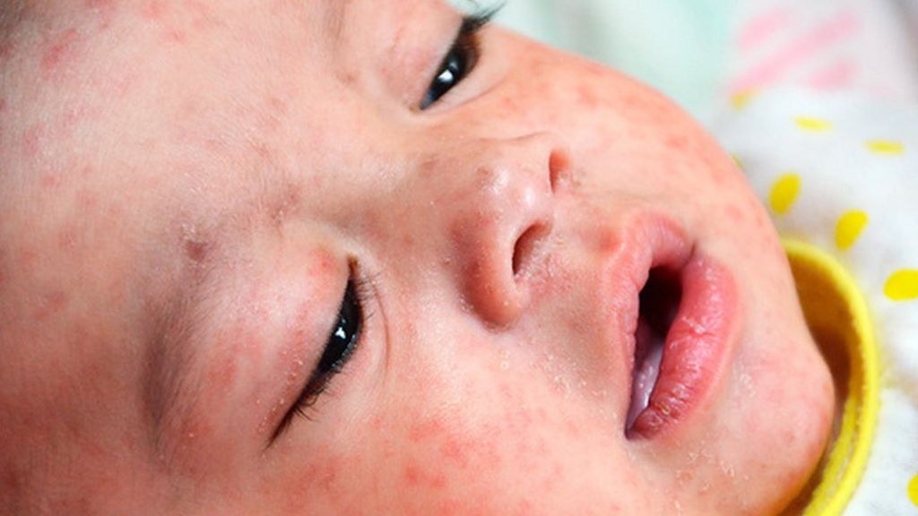 Measles Tragedy Kills Across Europe Bbc News