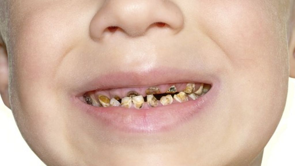 children teeth rotting health rotten tooth child bad removal stuff pain point